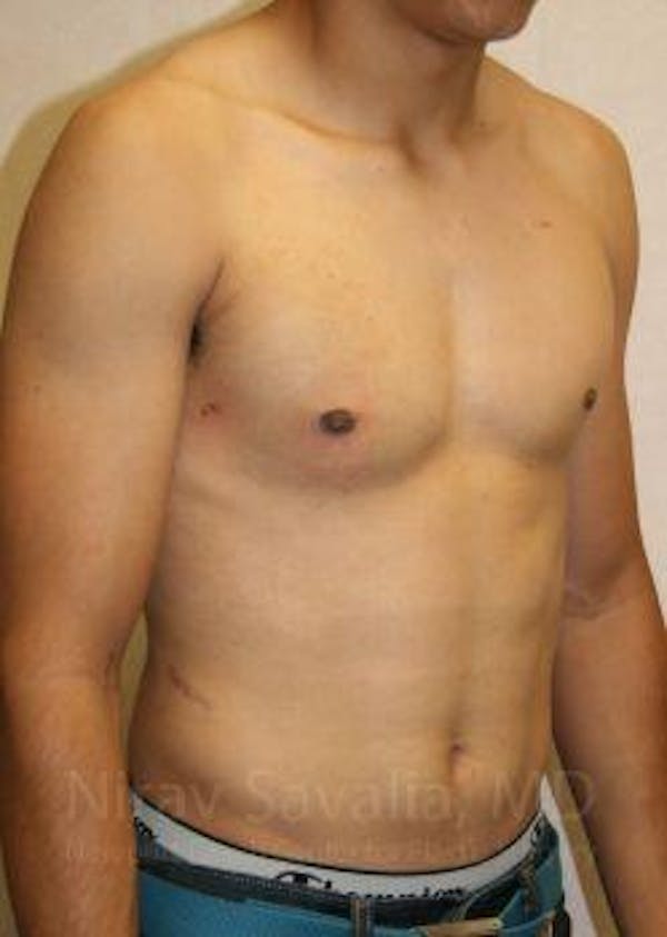 Male Breast Reduction Before & After Gallery - Patient 1655607 - Image 8