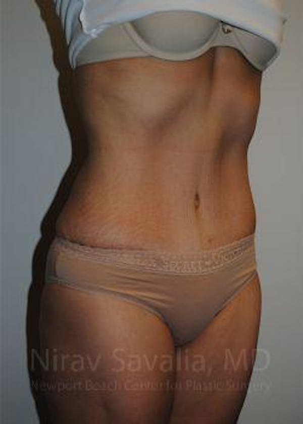 Liposuction Before & After Gallery - Patient 1655608 - Image 10