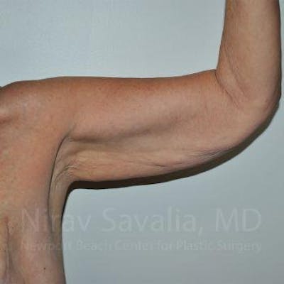 Arm Lift Before & After Gallery - Patient 1655610 - Image 1