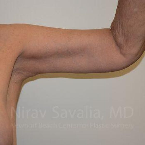 Arm Lift Before & After Gallery - Patient 1655610 - Image 2