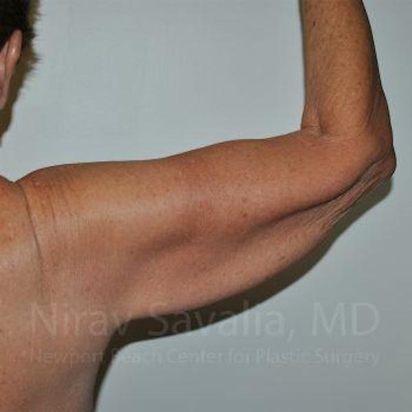 Arm Lift Before & After Gallery - Patient 1655610 - Image 3
