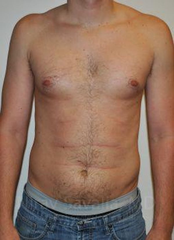 Male Breast Reduction Before & After Gallery - Patient 1655612 - Image 1
