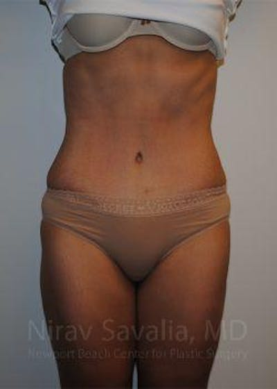 Body Contouring after Weight Loss Before & After Gallery - Patient 1655611 - Image 2