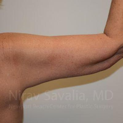 Arm Lift Before & After Gallery - Patient 1655610 - Image 4