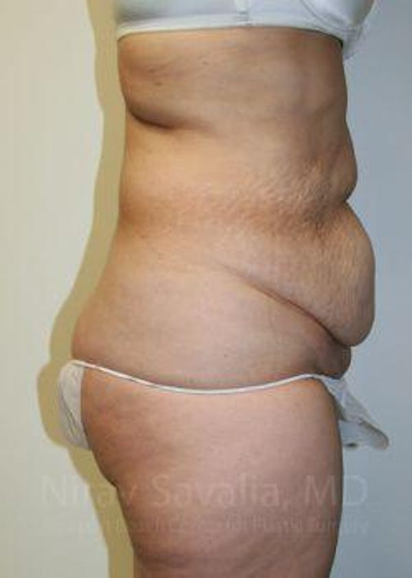 Body Contouring after Weight Loss Before & After Gallery - Patient 1655611 - Image 3