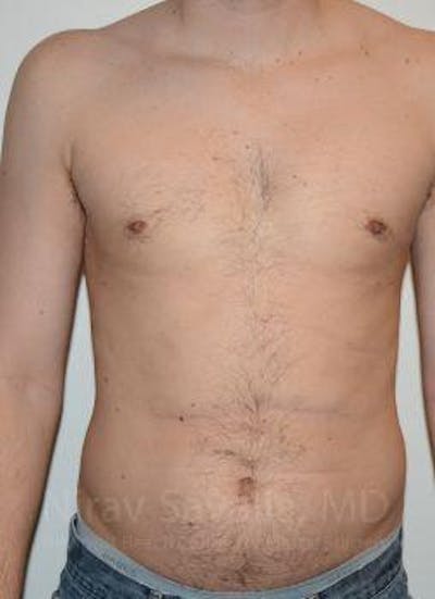 Male Breast Reduction Before & After Gallery - Patient 1655612 - Image 2