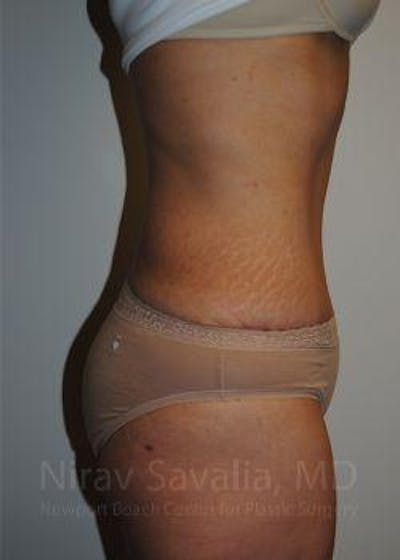 Body Contouring after Weight Loss Before & After Gallery - Patient 1655611 - Image 4