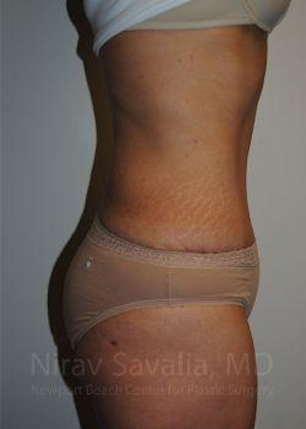 Body Contouring after Weight Loss Before & After Gallery - Patient 1655611 - Image 4