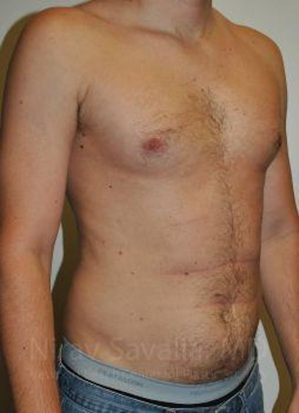 Male Breast Reduction Before & After Gallery - Patient 1655612 - Image 3