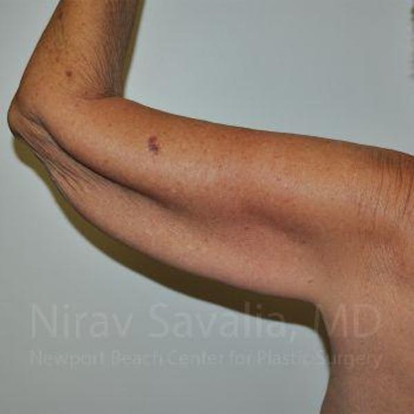 Arm Lift Before & After Gallery - Patient 1655610 - Image 5