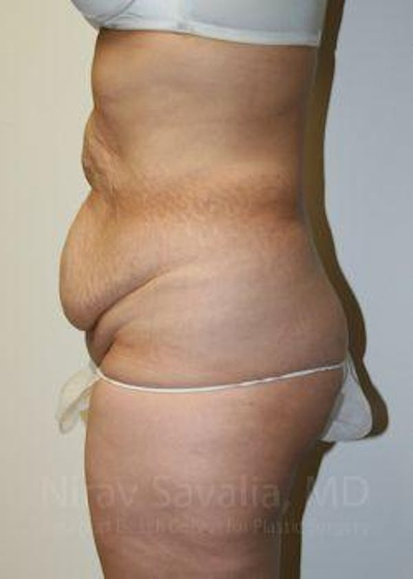 Body Contouring after Weight Loss Before & After Gallery - Patient 1655611 - Image 5