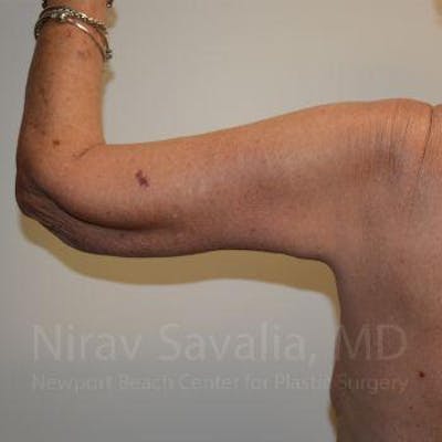 Arm Lift Before & After Gallery - Patient 1655610 - Image 6