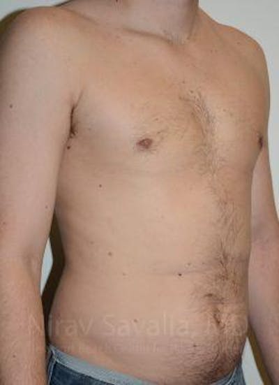 Male Breast Reduction Before & After Gallery - Patient 1655612 - Image 4