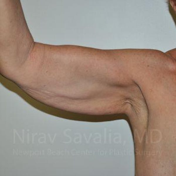 Arm Lift Before & After Gallery - Patient 1655610 - Image 7