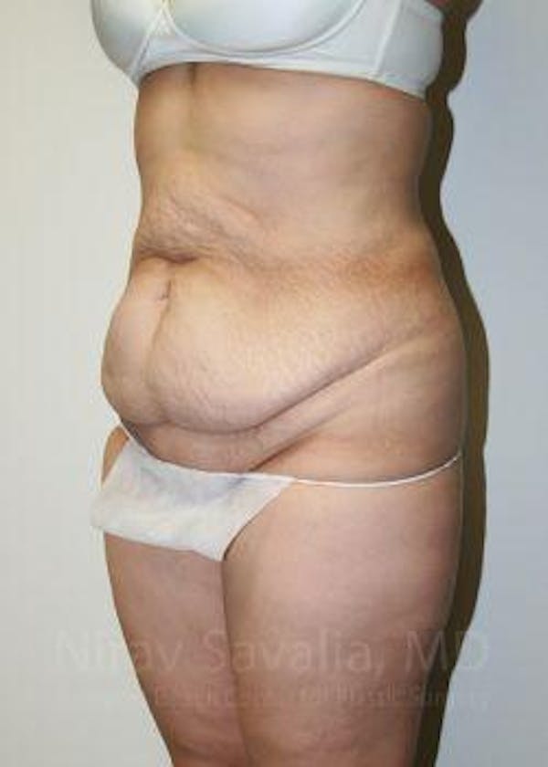 Body Contouring after Weight Loss Before & After Gallery - Patient 1655611 - Image 7