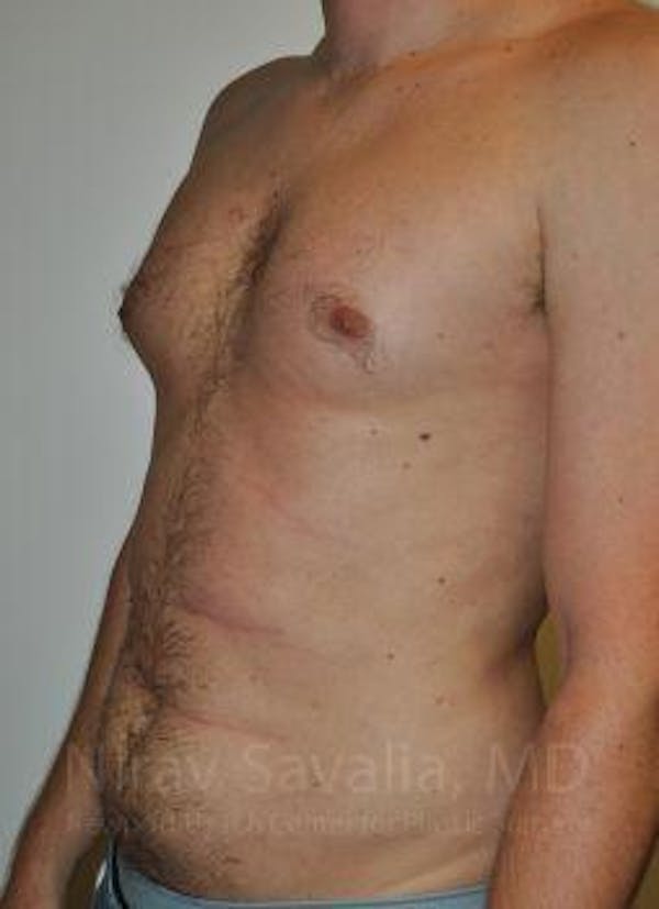 Male Breast Reduction Before & After Gallery - Patient 1655612 - Image 5