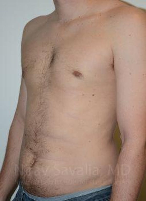 Male Breast Reduction Before & After Gallery - Patient 1655612 - Image 6