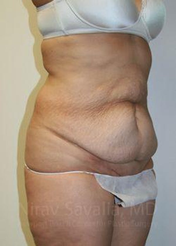 Body Contouring after Weight Loss Before & After Gallery - Patient 1655611 - Image 9