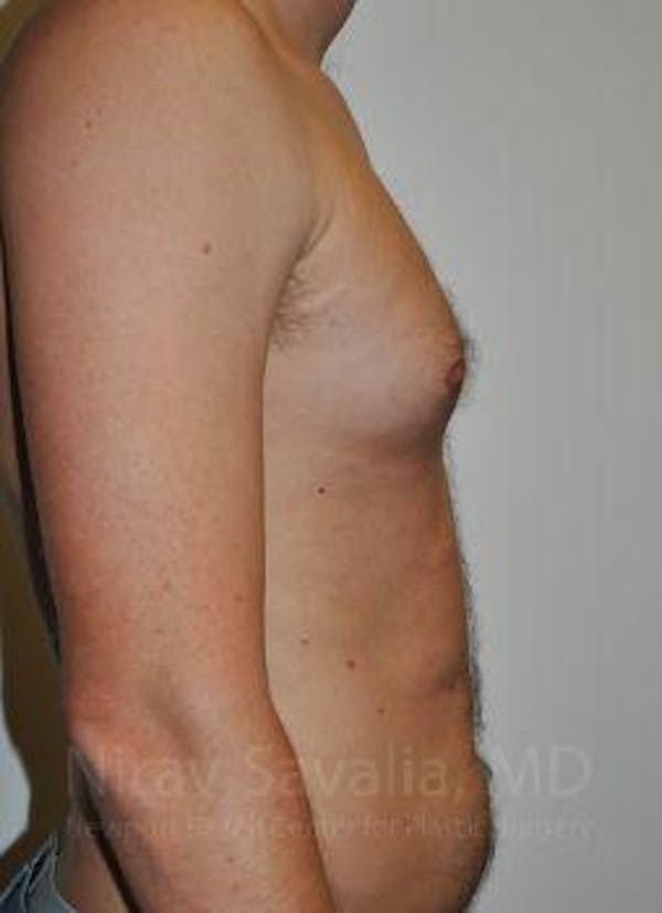 Male Breast Reduction Before & After Gallery - Patient 1655612 - Image 7