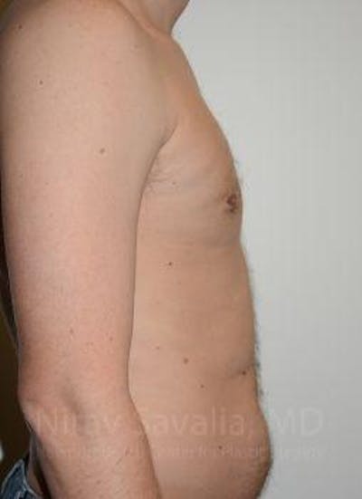 Male Breast Reduction Before & After Gallery - Patient 1655612 - Image 8