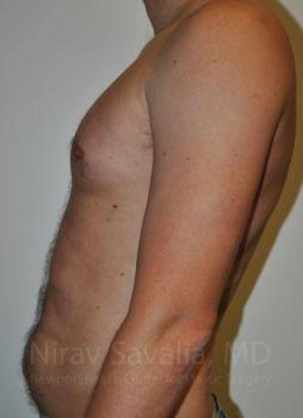 Male Breast Reduction Before & After Gallery - Patient 1655612 - Image 9