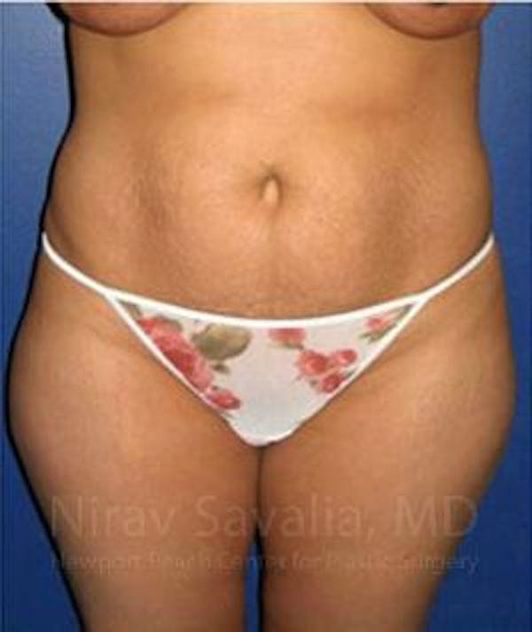 Abdominoplasty / Tummy Tuck Gallery - Patient 1655614 - Image 1