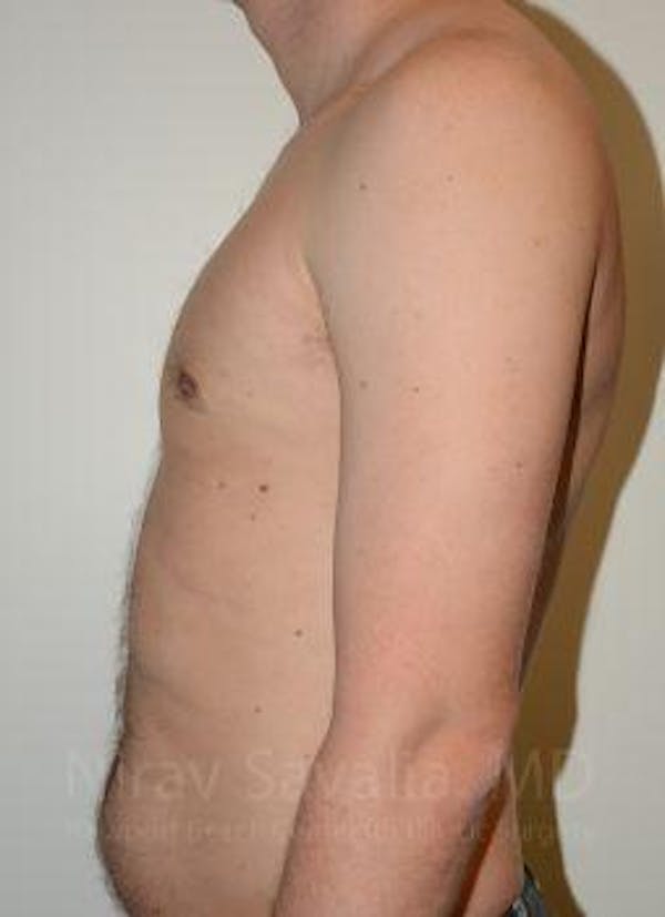Male Breast Reduction Before & After Gallery - Patient 1655612 - Image 10