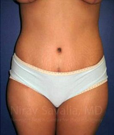 Abdominoplasty / Tummy Tuck Before & After Gallery - Patient 1655614 - Image 2