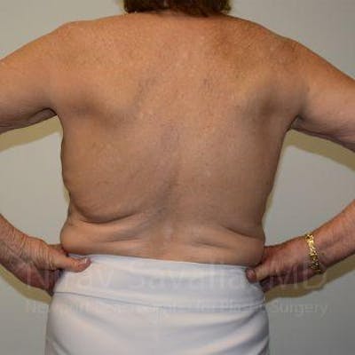 Body Contouring after Weight Loss Gallery - Patient 1655616 - Image 1