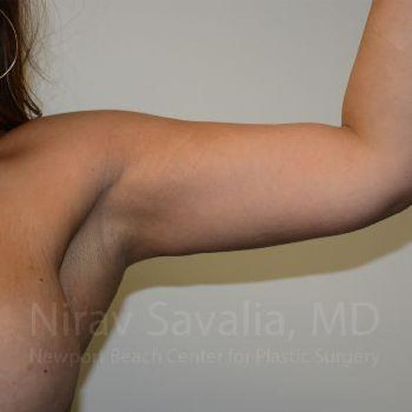 Arm Lift Before & After Gallery - Patient 1655615 - Image 4