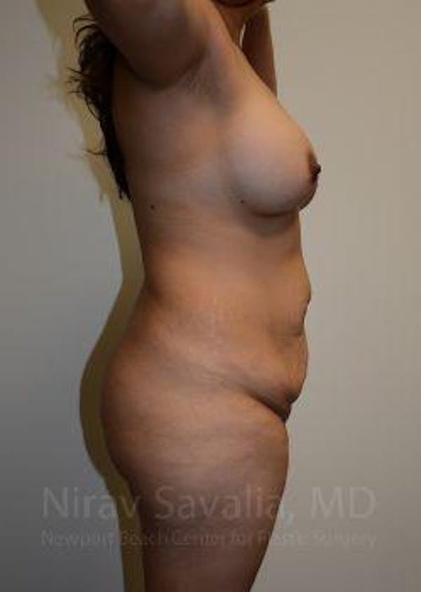 Mommy Makeover Before & After Gallery - Patient 1655618 - Image 5