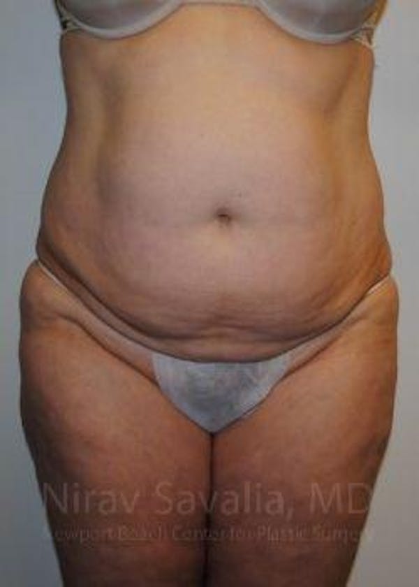 Abdominoplasty / Tummy Tuck Before & After Gallery - Patient 1655617 - Image 1