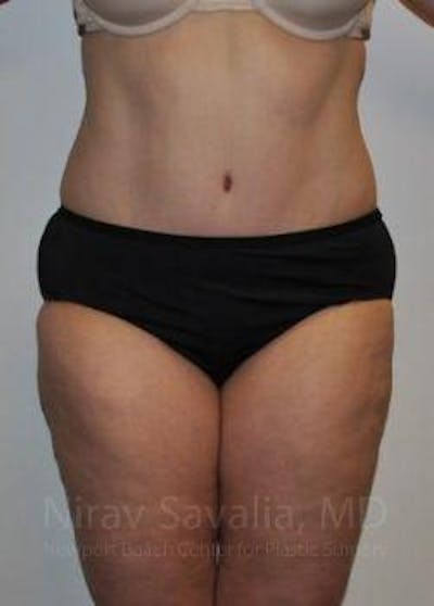 Abdominoplasty / Tummy Tuck Before & After Gallery - Patient 1655617 - Image 2