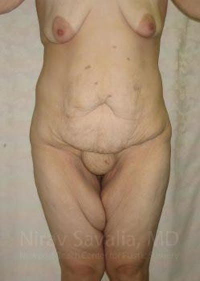 Body Contouring after Weight Loss Before & After Gallery - Patient 1655620 - Image 1