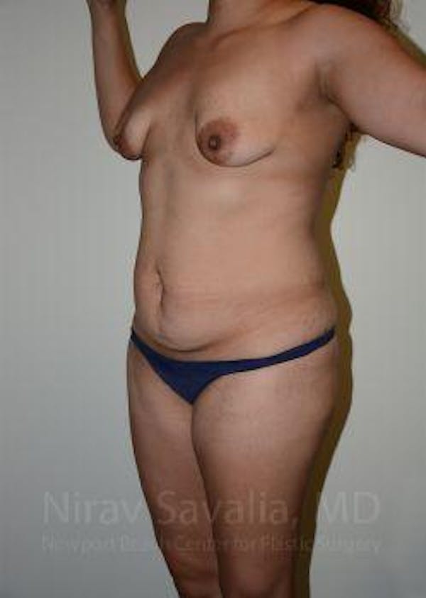 Liposuction Before & After Gallery - Patient 1655619 - Image 7