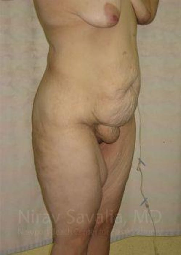 Body Contouring after Weight Loss Before & After Gallery - Patient 1655620 - Image 3
