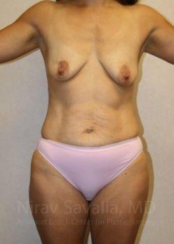 Abdominoplasty / Tummy Tuck Before & After Gallery - Patient 1655621 - Image 1
