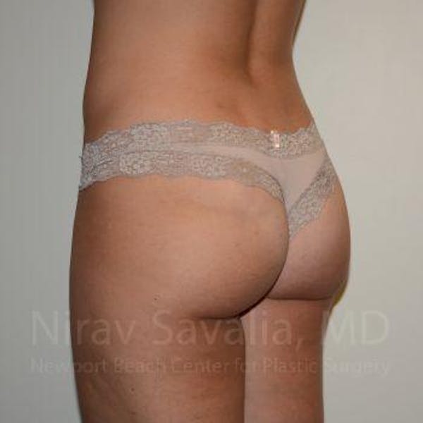 Liposuction Before & After Gallery - Patient 1655622 - Image 4