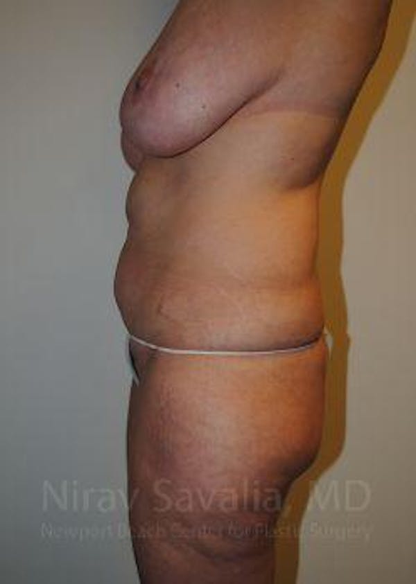 Body Contouring after Weight Loss Before & After Gallery - Patient 1655628 - Image 3
