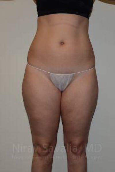 Liposuction Before & After Gallery - Patient 1655629 - Image 1