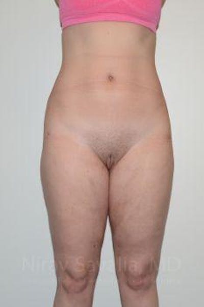 Liposuction Gallery - Patient 1655629 - Image 2