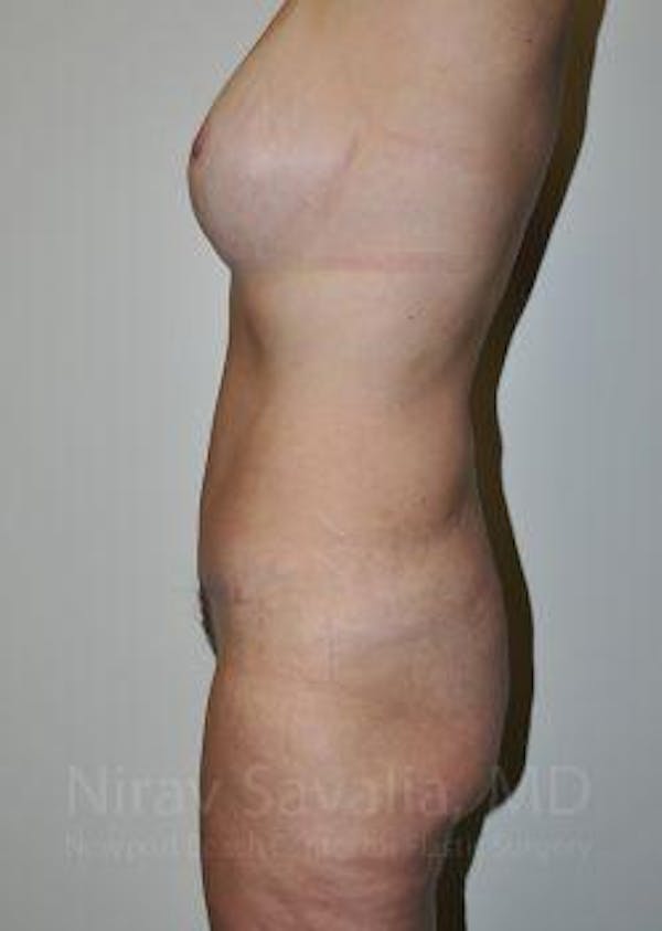 Body Contouring after Weight Loss Before & After Gallery - Patient 1655628 - Image 4