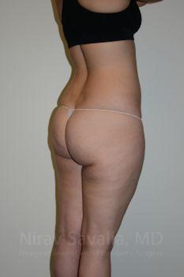 Liposuction Before & After Gallery - Patient 1655629 - Image 3