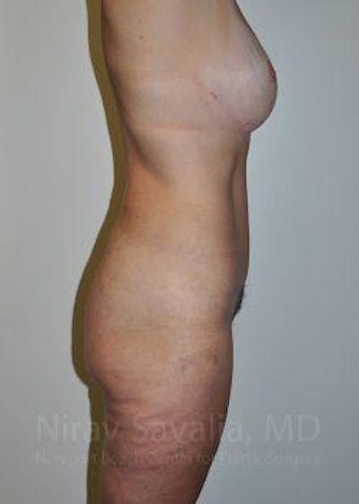 Body Contouring after Weight Loss Before & After Gallery - Patient 1655628 - Image 6