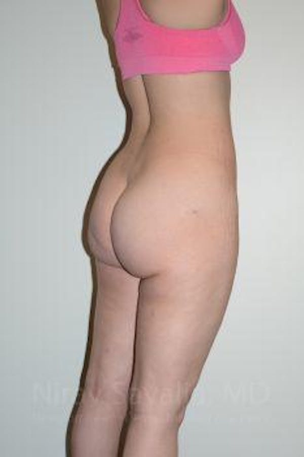 Liposuction Before & After Gallery - Patient 1655629 - Image 4