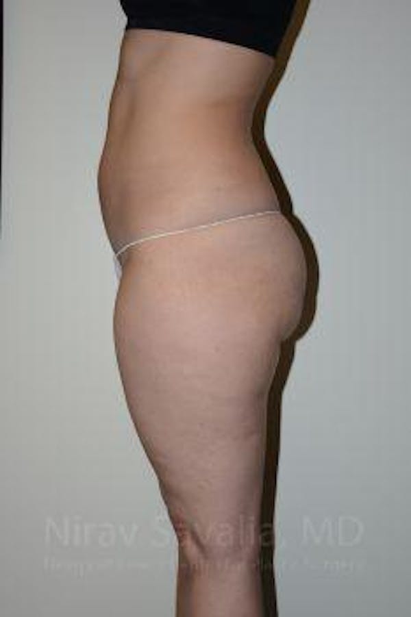 Liposuction Before & After Gallery - Patient 1655629 - Image 7