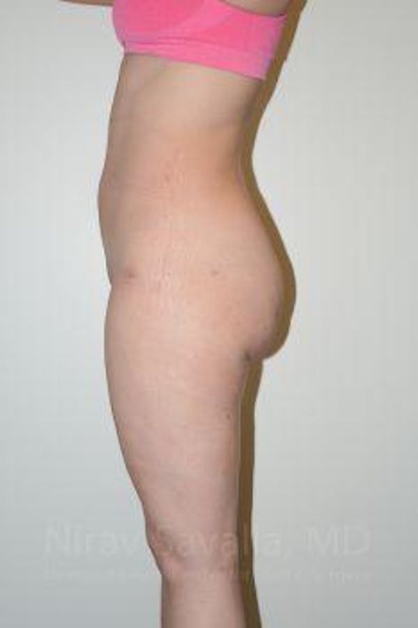 Liposuction Before & After Gallery - Patient 1655629 - Image 8