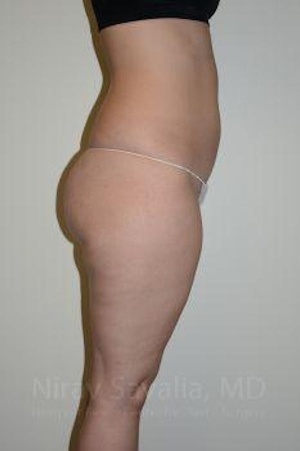 Liposuction Before & After Gallery - Patient 1655629 - Image 9