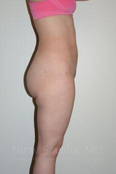 Liposuction Before & After Gallery - Patient 1655629 - Image 10