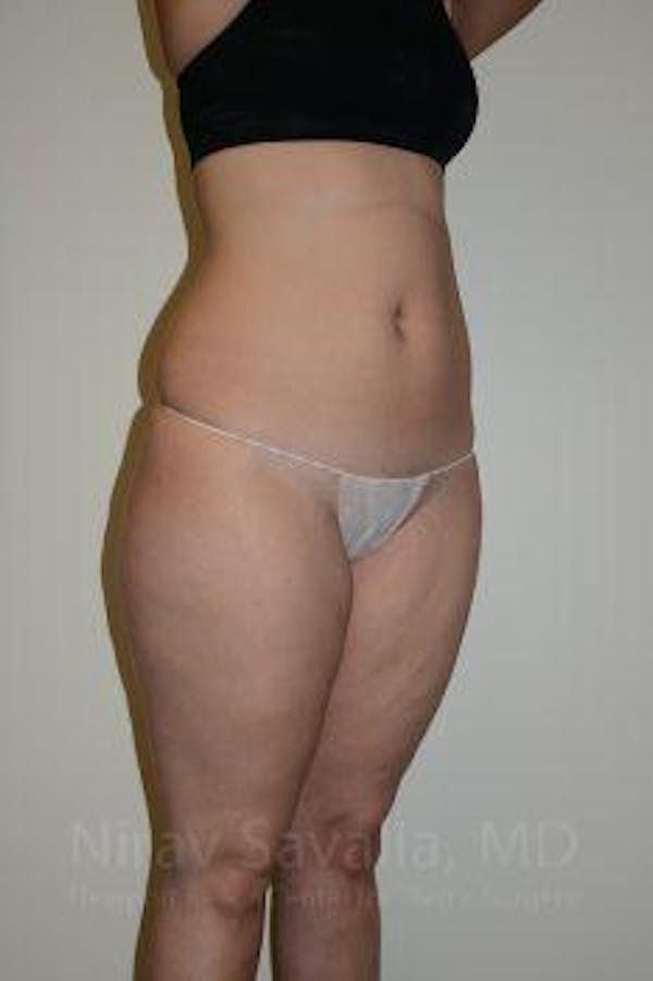 Liposuction Before & After Gallery - Patient 1655629 - Image 11